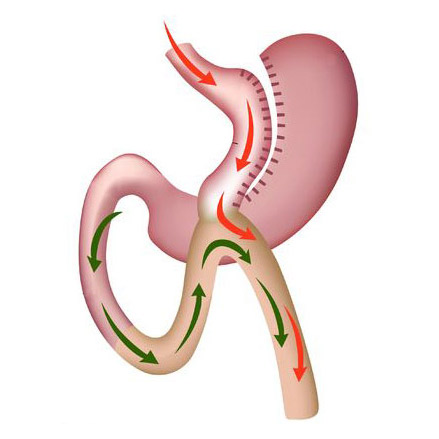 Mini Bypass Gástrico
