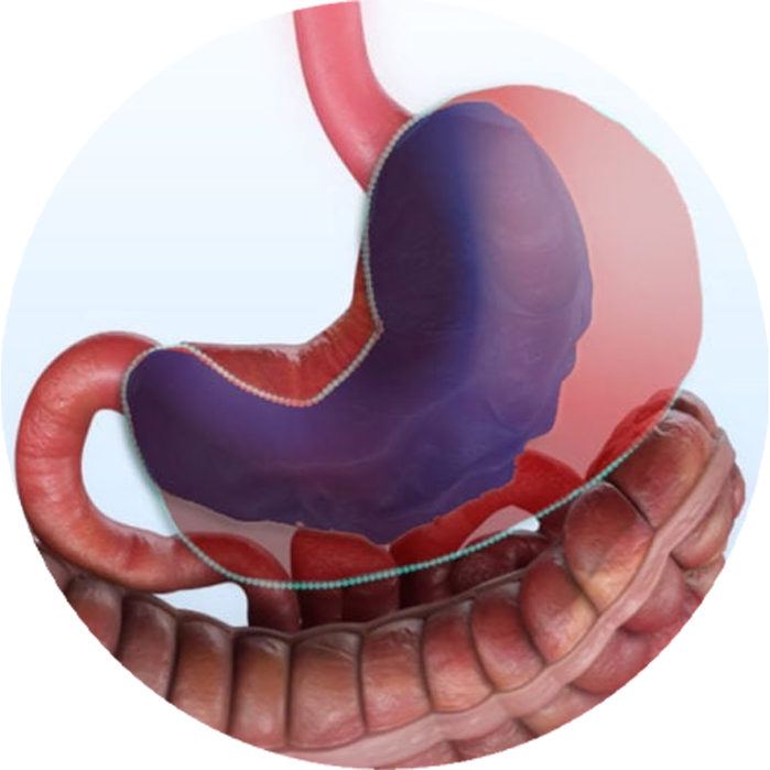 Gastroplastia Endoscópica